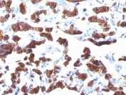 Thyroglobulin Antibody / TG Thyroid Hormone Precursor Protein Antibody (clone TGB24). Immunohistochemistry analysis of human thyroid carcinoma tissue. FFPE human thyroid carcinoma sections demonstrate strong HRP-DAB brown cytoplasmic staining in tumor epithelial cells arranged in follicular and gland-like structures, consistent with thyroglobulin production by differentiated thyroid follicular cells. Intense brown chromogenic signal is also observed within luminal colloid material, reflecting the accumulation of this thyroid hormone precursor protein secreted by follicular epithelial cells. Tumor cell cytoplasm shows diffuse granular positivity, while surrounding stromal elements exhibit minimal staining. Nuclear hematoxylin counterstain is visible in blue. Heat induced epitope retrieval was performed in 10 mM Tris with 1 mM EDTA, pH 9.0, by boiling tissue sections for 10-20 minutes followed by cooling at room temperature for 20 minutes prior to antibody incubation.