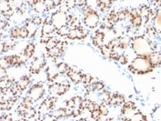 Immunohistochemistry of TTF-1 Antibody / Thyroid Tumor Marker Antibody in human thyroid tissue. Formalin-fixed, paraffin-embedded human thyroid tissue stained using TTF-1 Antibody / Thyroid Tumor Marker Antibody. The mouse monoclonal clone NX2.1/690 antibody shows strong nuclear staining in thyroid follicular epithelial cells lining the thyroid follicles. Nuclear immunoreactivity for Thyroid transcription factor 1 (NKX2-1) is characteristic of thyroid follicular epithelium and supports the use of this antibody as a thyroid tumor marker in immunohistochemistry. This staining pattern highlights thyroid epithelial lineage and reflects the established role of TTF-1 as a diagnostic marker used in endocrine pathology to identify thyroid follicular tumors and thyroid carcinoma in surgical pathology panels.