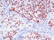Immunohistochemistry of TTF-1 Antibody / Lung and Thyroid Diagnostic Marker Antibody in human lung carcinoma. Formalin-fixed, paraffin-embedded human lung carcinoma stained using TTF-1 Antibody / Lung and Thyroid Diagnostic Marker Antibody. The mouse monoclonal clones 8G7G3/1 + NX2.1/690 antibodies demonstrate strong nuclear staining in malignant pulmonary epithelial cells, consistent with the nuclear localization of Thyroid transcription factor 1 (NKX2-1). Nuclear TTF-1 immunoreactivity is widely used in surgical pathology as a diagnostic marker for tumors of pulmonary epithelial origin, particularly pulmonary adenocarcinoma and small cell lung carcinoma. Because NKX2-1 expression is associated with epithelial cells of lung and thyroid lineage, TTF-1 antibody staining is routinely incorporated into immunohistochemistry tumor panels to assist in determining tumor origin and to help distinguish primary lung carcinoma from metastatic carcinomas involving the lung.