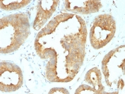 IHC analysis of formalin-fixed, paraffin-embedded human breast carcinoma tissue stained with GRP94 antibody (clone 9G10.F8.2). HIER: boil tissue sections in pH 9 10mM Tris with 1mM EDTA for 20 min and allow to cool before testing.