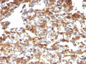 Vimentin Antibody / Intracellular Transport Marker Antibody Melanoma IHC. Immunohistochemistry analysis of FFPE human melanoma tissue using Vimentin antibody shows strong HRP-DAB brown cytoplasmic staining in tumor-associated stromal cells and spindle-shaped mesenchymal populations, with variable staining in melanoma cells. The mouse monoclonal clone VM1170 highlights filamentous cytoplasmic networks distributed around the nucleus and extending throughout the cytoplasm, consistent with cytoskeletal organization involved in organelle positioning. The distribution of Vimentin-positive cells and subcellular pattern supports its role in intracellular organization and transport-associated cytoskeletal structure.