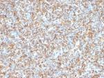 Vimentin Antibody Ewing's Sarcoma IHC.  Immunohistochemistry analysis of formalin-fixed, paraffin-embedded human Ewing's sarcoma stained with anti-Vimentin antibody (clone VM1170).