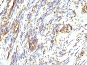 Vimentin Antibody Leiomyosarcoma IHC.  Immunohistochemistry analysis of formalin-fixed, paraffin-embedded human Leiomyosarcoma stained with anti-Vimentin antibody (clone VM1170).
