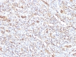 Vimentin Antibody / Intracellular Transport Marker Antibody Rhabdomyosarcoma IHC. Immunohistochemistry analysis of FFPE human rhabdomyosarcoma tissue using Vimentin antibody shows moderate to strong HRP-DAB brown cytoplasmic staining in tumor cells with spindle-shaped and pleomorphic morphology. The mouse monoclonal clone VM1170 highlights filamentous cytoplasmic structures distributed around the nucleus and extending through the cytoplasm, consistent with cytoskeletal organization associated with organelle positioning. The subcellular staining pattern supports the role of Vimentin in intracellular organization and transport-related cytoskeletal structure in tumor cells.