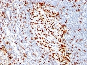 ZAP70 Antibody / Signal Amplification Pathway Antibody. Immunohistochemistry analysis of formalin-fixed, paraffin-embedded human tonsil tissue using ZAP70 Antibody / Signal Amplification Pathway Antibody (clone ZAP70/528). Cytoplasmic HRP-DAB brown staining is observed in lymphoid cell populations within tonsillar follicles and interfollicular regions, with clusters of strongly positive cells contrasted against lighter surrounding areas. This pattern is consistent with Zeta-chain-associated protein kinase 70 (ZAP70) expression in lymphocytes and reflects amplification of intracellular signaling cascades following receptor engagement. The staining highlights regions of intensified signaling activity where signal propagation and pathway expansion contribute to robust immune responses within lymphoid tissue architecture.