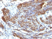 CAD Antibody / Caldesmon CALD1 Isoform-Specific Functional Protein Antibody. Immunohistochemistry analysis of Caldesmon (CALD1) in human uterus tissue. FFPE human uterus stained with CAD Antibody, clone CALD1/820, demonstrates strong HRP-DAB brown cytoplasmic staining in smooth muscle cells of the myometrium. The staining highlights interlacing bundles of elongated, spindle-shaped cells with dense filamentous cytoplasmic signal consistent with expression of high molecular weight caldesmon isoforms associated with contractile smooth muscle phenotype. Surrounding stromal and epithelial cells show minimal staining, supporting isoform-dependent localization of CALD1 within smooth muscle structures.