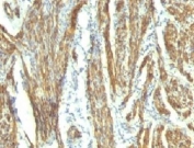 CAD Antibody / Caldesmon CALD1 Tumor Differentiation Marker Antibody. Immunohistochemistry analysis of Caldesmon (CALD1) in human uterus tissue. FFPE human uterus stained with CAD Antibody, clones CALD1/820 and h-CALD, demonstrates strong HRP-DAB brown cytoplasmic staining in smooth muscle cells of the myometrium. The staining highlights interlacing bundles of elongated, spindle-shaped cells consistent with smooth muscle differentiation and contractile cytoskeletal organization. Surrounding stromal and epithelial cells show minimal staining, supporting the role of CALD1 as a tumor differentiation marker associated with smooth muscle lineage and cellular origin.