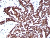 Cyclin B1 Antibody Ovarian Carcinoma IHC. Immunohistochemistry staining of FFPE human ovarian carcinoma tissue using Cyclin B1 Antibody / Cell Cycle Regulator Antibody demonstrates strong nuclear HRP-DAB brown staining throughout malignant epithelial cell populations. The staining pattern is consistent with elevated Cyclin B1 expression in actively proliferating tumor cells and highlights the role of Cyclin B1 as a central regulator of G2/M phase progression and mitotic entry. Cyclin B1 forms a functional complex with CDK1 to coordinate chromosome condensation, spindle assembly, and cell division, making it a widely utilized marker of cell cycle activity and proliferative status. The extensive nuclear staining observed in this ovarian carcinoma specimen is consistent with the increased proliferative activity characteristic of many malignant epithelial tumors.