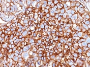CD44 Antibody Breast Carcinoma IHC. Immunohistochemistry analysis of CD44 / CD44 antigen expression in FFPE human breast carcinoma tissue using Cancer Stem Cell Marker Antibody clone HCAM/918. Membranous HRP-DAB brown staining is observed in tumor epithelial cells, outlining cell borders and highlighting cell surface localization. The staining pattern demonstrates heterogeneous intensity across the tumor, with subsets of strongly positive cells within the broader population, consistent with enrichment of CD44-expressing subpopulations. This pattern supports its use for evaluating tumor heterogeneity, cellular organization, and identification of stem-like cell populations in breast carcinoma tissue.