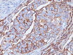 CD44 Antibody Breast Carcinoma IHC. Immunohistochemistry analysis of CD44 / CD44 antigen expression in FFPE human breast carcinoma using mouse monoclonal antibody clone DF1485. Membranous HRP-DAB brown staining is observed in tumor epithelial cells, outlining cell borders and highlighting cell surface localization consistent with CD44 expression. The staining pattern demonstrates heterogeneous intensity across tumor cells and supports its use for evaluating CD44 distribution and cellular organization in breast carcinoma tissue. Heat induced epitope retrieval was performed by boiling tissue sections in pH 9 10mM Tris with 1mM EDTA for 20 min followed by cooling at RT before testing.