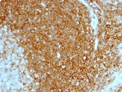 HCAM Antibody Tonsil IHC. Immunohistochemistry analysis of HCAM / CD44 expression in FFPE human tonsil tissue using Cell Adhesion and Lymphoid Architecture Marker Antibody clone HCAM/1097. Strong membranous HRP-DAB brown staining is observed in dense lymphoid cell populations, outlining cell borders and highlighting cohesive cell-cell interactions consistent with HCAM/CD44-mediated adhesion. The staining pattern demonstrates organized lymphoid architecture with clustered cellular regions and supports its use for evaluating tissue structure, cell density, and adhesion-driven organization in tonsil tissue.