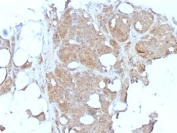 Major Vault Protein Antibody for IHC. Immunohistochemistry analysis of Major Vault Protein (MVP / LRP) expression in formalin-fixed, paraffin-embedded human breast carcinoma using clone 1032 mouse monoclonal antibody. Tumor epithelial cells show moderate to strong cytoplasmic HRP-DAB brown staining with a diffuse pattern and focal granular accentuation, consistent with intracellular vault complex localization, while surrounding stromal and adipose tissues display minimal to low background staining. The signal highlights malignant epithelial cell populations within tumor nests, supporting the role of Major vault protein in tumor cell survival and cellular stress response pathways.