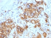CA19-9 Antibody Gastric Carcinoma IHC. Immunohistochemistry of FFPE human gastric carcinoma tissue using CA19-9 antibody shows strong HRP-DAB brown membranous and cytoplasmic staining in tumor epithelial cells, consistent with Sialyl-Lewis A expression in gastrointestinal adenocarcinoma and mucin-associated carbohydrate antigen localization; detection was performed with clone 121SLE.