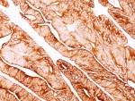 IHC analysis of formalin-fixed, paraffin-embedded human colon carcinoma stained with Cytokeratin 5/8 antibody (clone C-50). Required HIER: digest sections with Trypsin at 1mg/ml, 15 min, at RT.