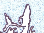 IHC: Formalin-fixed, paraffin-embedded human ovarian carcinoma stained with Cytokeratin 8/18 antibody (KRT8/803 + KRT18/835).