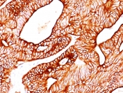 IHC: Formalin-fixed, paraffin-embedded human colon carcinoma stained with Cytokeratin 8/18 antibody (KRT8/803 + KRT18/835).
