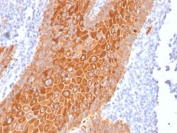Pan Cytokeratin Antibody human squamous cell carcinoma IHC. Immunohistochemistry analysis of cytokeratin expression in FFPE human squamous cell carcinoma using Pan Cytokeratin antibody clone PAN-CK. Strong cytoplasmic HRP-DAB brown staining highlights malignant epithelial cells, clearly delineating tumor nests and cellular architecture within the surrounding stromal background. The staining pattern confirms epithelial origin and supports identification of carcinoma cells in tissue sections. HIER was performed by boiling tissue sections in pH 9 10 mM Tris with 1 mM EDTA for 20 minutes followed by cooling prior to antibody incubation.