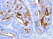 CA19-9 Antibody Colon Carcinoma Immunohistochemistry. IHC staining of formalin-fixed, paraffin-embedded human colon carcinoma stained with CA19-9 antibody (SPM588).