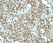 Nuclear Antigen Antibody Tonsil Germinal Center IHC. Immunohistochemistry staining of FFPE human tonsil tissue using Nuclear Antigen Antibody / Pan-Nuclear Marker Antibody (clone NM106) demonstrates intense and widespread nuclear HRP-DAB brown staining throughout densely populated lymphoid cell compartments. The staining pattern is consistent with recognition of a broadly expressed nuclear-associated antigen and highlights the nuclei of lymphocytes and other resident tonsillar cells with minimal cytoplasmic background. Strong nuclear localization provides excellent visualization of cellular density, tissue architecture, and nuclear distribution within the lymphoid microenvironment. As a pan-nuclear marker, clone NM106 is useful for identification of nuclei, assessment of cell-rich tissue regions, and evaluation of subcellular localization in histological specimens. The observed staining demonstrates robust nuclear labeling across the tonsillar lymphoid population.
