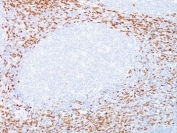 CD8A Antibody Tonsil IHC Staining. Immunohistochemistry analysis of CD8 alpha (CD8A) in FFPE human tonsil tissue shows membranous staining of cytotoxic T lymphocytes outlining cell surfaces within lymphoid regions, consistent with CD8A localization as a lymphocyte surface marker and enabling clear identification of CD8-positive T cell populations in tissue (clones C8/468 and C8/144B).