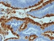 Lewis b Antibody Colon Carcinoma IHC. Immunohistochemistry analysis of FFPE human colon carcinoma tissue stained with Lewis b Antibody demonstrates strong membranous and apical HRP-DAB brown staining throughout glandular epithelial tumor cell populations, consistent with expression of Lewis b-associated carbohydrate antigens within gastrointestinal-derived carcinoma tissue. This Lewis blood group antibody, clone 2-25LE also known as LWB01, highlights epithelial glycoconjugate organization and tumor-associated glycosylation pathways associated with gastrointestinal epithelial differentiation and mucin-related cellular signaling.