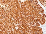 Melanoma Cell Marker Antibody Cocktail Immunohistochemistry. IHC: Formalin-fixed, paraffin-embedded human melanoma stained with melanoma Marker antibody cocktail (M2-7C10 + M2-9E3 + T311 + HMB45).