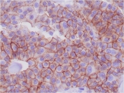 E-cadherin Breast Adenocarcinoma IHC. Immunohistochemistry of formalin-fixed, paraffin-embedded human breast adenocarcinoma stained with E-Cadherin antibody (CDH1/1525).