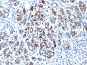 Alpha-1-Antichymotrypsin Antibody Pancreas IHC. Immunohistochemistry of Alpha-1-antichymotrypsin / SERPINA3 in FFPE human pancreas using a mouse monoclonal Alpha-1-antichymotrypsin antibody, clone AACT/1451. Cytoplasmic HRP-DAB brown staining is observed in glandular epithelial cells and scattered stromal or immune-associated cells, consistent with secreted protein localization and inflammatory component involvement, while nuclei are counterstained blue. Antigen retrieval was performed by steaming sections in pH 6 10 mM citrate buffer for 10â20 min prior to staining.