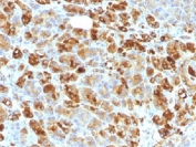Alpha-1-Antichymotrypsin Antibody Cocktail Human Pancreas IHC. Immunohistochemistry testing of FFPE human pancreas with Alpha-1-Antichymotrypsin antibody cocktail (clone AACT/1451 + AACT/1452). Required HIER: steam sections in pH6, 10mM citrate buffer for 10-20 min.