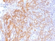 Beta-Catenin Reference Standard Antibody Tonsil IHC. Immunohistochemistry analysis of FFPE human tonsil tissue using Beta-Catenin Antibody (clone 6F9) shows membranous and cytoplasmic staining in epithelial components, consistent with CTNNB1 / Catenin beta-1 localization at adherens junctions and intracellular pools, with minimal staining in lymphoid regions. The observed pattern aligns with expected tissue-specific expression and supports use of this clone as a reference standard for consistent CTNNB1 detection. Hematoxylin counterstain provides nuclear contrast and structural context. HIER: boil FFPE tissue sections in 10 mM Tris with 1 mM EDTA, pH 9.0, for 10-20 min.