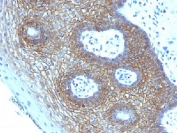 CD44v4 Antibody for IHC Cervical Squamous Cell Carcinoma. Immunohistochemistry analysis of CD44 variant 4 / CD44 expression in FFPE human cervical squamous cell carcinoma using mouse monoclonal antibody clone CD44v4/1219. Strong membranous HRP-DAB brown staining is observed in malignant squamous epithelial cells forming tumor nests, clearly outlining cell borders and preserving epithelial organization consistent with CD44v4-associated squamous differentiation and carcinoma identity. The staining pattern highlights cohesive tumor architecture and supports its use as a marker of epithelial lineage and structural integrity in squamous cell carcinoma. Heat induced epitope retrieval was performed by steaming tissue sections in pH 9 10mM Tris with 1mM EDTA buffer for 10-20 min.