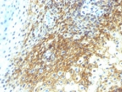 CD44v4 Antibody for IHC Tongue Squamous Cell Carcinoma. Immunohistochemistry analysis of CD44 variant 4 / CD44 expression in FFPE human tongue squamous cell carcinoma using mouse monoclonal antibody clone CD44v4/1219. Membranous HRP-DAB brown staining is observed in malignant squamous epithelial cells, outlining tumor cell borders and highlighting areas of cohesive and less organized growth consistent with CD44v4-associated squamous differentiation and carcinoma identity. The staining pattern supports its use as a marker of epithelial lineage and tumor architecture in squamous cell carcinoma of the tongue. Heat induced epitope retrieval was performed by steaming tissue sections in pH 9 10mM Tris with 1mM EDTA buffer for 10-20 min.