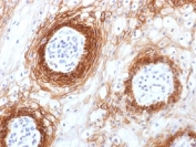 CD44v6 Antibody for IHC Tongue Carcinoma. Immunohistochemistry analysis of CD44 variant 6 / CD44 expression in FFPE human tongue carcinoma using mouse monoclonal antibody clone CD44v6/1246. Strong membranous HRP-DAB brown staining is observed in malignant squamous epithelial cells forming tumor nests, highlighting cell surface localization consistent with CD44v6-associated epithelial differentiation and squamous cell carcinoma identity. The staining pattern outlines tumor architecture and supports its use as a marker of squamous differentiation in oral epithelial malignancies. Heat induced epitope retrieval was performed by steaming tissue sections in pH 9 10mM Tris with 1mM EDTA buffer for 10-20 min.
