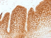CD44v6 Antibody for IHC Cervical Carcinoma. Immunohistochemistry analysis of CD44 variant 6 / CD44 expression in FFPE human cervical carcinoma using mouse monoclonal antibody clone CD44v6/1246. Strong membranous HRP-DAB brown staining is observed in malignant squamous epithelial cells, outlining tumor nests and preserving epithelial layering consistent with CD44v6-associated squamous differentiation and carcinoma identity. The staining pattern highlights organized tumor architecture and supports its use as a marker of squamous cell carcinoma in cervical epithelial malignancies. Heat induced epitope retrieval was performed by steaming tissue sections in pH 9 10mM Tris with 1mM EDTA buffer for 10-20 min.