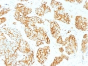 CD44v9 Antibody for IHC Tumor Tissue Prostate Carcinoma. Immunohistochemistry analysis of CD44 variant 9 / CD44 expression in FFPE human prostate carcinoma using mouse monoclonal antibody clone CD44v9/1459. Distinct membranous HRP-DAB brown staining is observed in malignant epithelial cells forming glandular structures, highlighting cell surface localization consistent with CD44v9-associated adhesion and tumor progression biology. The staining pattern demonstrates heterogeneous distribution across tumor glands, supporting its relevance for evaluating epithelial tumor organization and progression-associated changes within prostate carcinoma tissue. Heat induced epitope retrieval was performed by steaming tissue sections in pH 9 10mM Tris with 1mM EDTA buffer for 10-20 min.