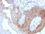 CD44v9 Antibody for IHC Tumor Tissue Tongue Carcinoma. Immunohistochemistry analysis of CD44 variant 9 / CD44 expression in FFPE human tongue carcinoma using mouse monoclonal antibody clone CD44v9/1459. Prominent membranous HRP-DAB brown staining is observed in malignant squamous epithelial cells, outlining tumor islands and highlighting cell surface localization consistent with CD44v9-associated adhesion and epithelial tumor progression. The staining pattern shows strong expression within squamous carcinoma regions, supporting its use in evaluating tumor organization and progression-related changes in oral epithelial malignancies. Heat induced epitope retrieval was performed by steaming tissue sections in pH 9 10mM Tris with 1mM EDTA buffer for 10-20 min.