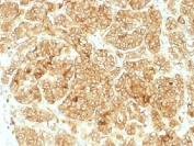 EpCAM Antibody Renal Cell Carcinoma IHC. Immunohistochemistry testing of FFPE human renal cell carcinoma and EpCAM antibody. Required HIER: steam sections in pH6 citrate buffer for 10-20 min.