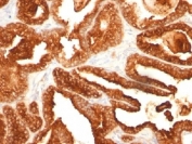 PAP Antibody immunohistochemistry analysis of Prostatic acid phosphatase / ACP3 in human prostate carcinoma tissue. FFPE human prostate carcinoma tissue was stained with PAP Antibody (mouse monoclonal, clone SPM312). Heat induced epitope retrieval was performed by boiling tissue sections in pH 9 Tris-EDTA buffer (10mM Tris, 1mM EDTA) for 10-20 minutes followed by cooling at room temperature prior to staining. HRP-DAB brown chromogenic signal highlights strong cytoplasmic staining of prostate tumor epithelial cells forming glandular carcinoma structures, consistent with the known localization of Prostatic acid phosphatase (ACP3 / PAP) in prostate-derived epithelial cells. Detection of PAP expression by immunohistochemistry is widely used in prostate cancer research and prostate pathology studies to identify prostate epithelial lineage and evaluate Prostatic acid phosphatase expression in prostate carcinoma tissues.