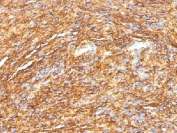 IHC testing of FFPE human gastrointestinal stromal tumor (GIST) with DOG 1 antibody (DG1/1484). Required HIER: boil tissue sections in pH 9 10mM Tris with 1mM EDTA for 10-20 min.