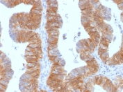 EpCAM Antibody Ovarian Carcinoma IHC. Immunohistochemistry testing of FFPE human ovarian carcinoma and EpCAM antibody (clone EGP40/1384). Required HIER: steam sections in pH6 citrate buffer for 10-20 min.