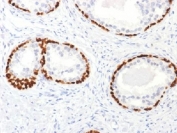 p63 Antibody Prostate Cancer IHC. Immunohistochemistry analysis of Tumor protein 63 (TP63) in FFPE human prostate cancer tissue using a p63 antibody as a prostate gland basal cell layer marker demonstrates strong HRP-DAB brown nuclear staining outlining basal cells in benign glands, forming a continuous ring-like pattern along the gland periphery. In contrast, malignant glands lack this basal cell layer and show little to no nuclear staining, reflecting disruption of normal epithelial architecture. The staining clearly delineates glandular structure and highlights the presence or absence of basal cells within adjacent regions of the same tissue section. This distinct nuclear pattern supports accurate interpretation of glandular organization and basal cell integrity. Heat-induced epitope retrieval was performed by boiling tissue sections in pH 9 10mM Tris with 1mM EDTA for 10-20 minutes prior to antibody incubation.