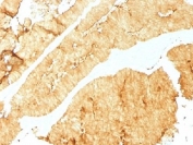 Villin Antibody. Immunohistochemistry analysis of Villin-1 (VIL1) in FFPE human colon using Villin Antibody / Epithelial Tumor Marker Antibody with mouse monoclonal clone VIL1/1325. Strong HRP-DAB brown staining is observed in epithelial cells with prominent membranous and apical localization, highlighting glandular structures characteristic of colorectal tissue. The staining pattern supports identification of epithelial tumor cells and reinforces Villin as an epithelial tumor marker associated with gastrointestinal malignancies, including colorectal cancer.