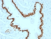 IHC testing of FFPE human lung carcinoma with SOX-2 antibody (clone SOX2/1791). Required HIER: boil tissue sections in 10mM citrate buffer, pH 6, for 10-20 min followed by cooling at RT for 20 min.