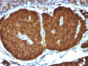 NSE Antibody human pheochromocytoma IHC staining. Immunohistochemistry analysis of Neuron Specific Enolase in FFPE human pheochromocytoma using NSE Antibody / Neuronal Differentiation Marker Antibody clone ENO2/1375 demonstrates strong cytoplasmic HRP-DAB brown staining in tumor cells, consistent with neuronal and neuroendocrine differentiation, while surrounding stromal components show minimal staining. The staining pattern highlights tumor cell populations with differentiated neuronal lineage characteristics and supports identification of neuroendocrine tumor features. Heat-induced epitope retrieval was performed using pH 9 Tris-EDTA buffer for 10-20 min prior to staining.