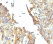 Alkaline Phosphatase Antibody Ovarian Carcinoma IHC. Immunohistochemistry testing of FFPE ovarian carcinoma and Alkaline Phosphatase antibody (KSUL-1). Required HIER: boil tissue sections in 10mM Tris with 1mM EDTA, pH 9, for 10-20 min followed by cooling at RT for 20 min.