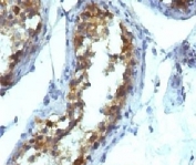 Alkaline Phosphatase Antibody Testicular Carcinoma IHC. Immunohistochemistry testing of FFPE testicular carcinoma and Alkaline Phosphatase antibody (KSUL-1). Required HIER: boil tissue sections in 10mM Tris with 1mM EDTA, pH 9, for 10-20 min followed by cooling at RT for 20 min.