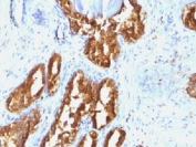 Prostate Acid Phosphatase Antibody immunohistochemistry analysis of PAP / ACP3 in human prostate carcinoma tissue. FFPE human prostate carcinoma tissue was stained with Prostate Acid Phosphatase Antibody (mouse monoclonal, clone ACPP/1338). Heat induced epitope retrieval was performed by boiling tissue sections in pH 9 Tris-EDTA buffer (10mM Tris, 1mM EDTA) for 10-20 minutes followed by cooling at room temperature prior to staining. HRP-DAB brown chromogenic signal highlights strong cytoplasmic staining of prostate tumor epithelial cells forming glandular carcinoma structures, consistent with the known localization of Prostatic acid phosphatase (ACP3 / PAP) in prostate-derived epithelial cells. Detection of PAP expression by immunohistochemistry is widely used in prostate cancer research and pathology studies to identify prostate epithelial lineage and evaluate Prostatic acid phosphatase expression in prostate carcinoma tissues.