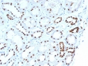 PAX8 Antibody Clone PAX8/1492 / Paired Box Protein Pax-8 Antibody immunohistochemistry in human renal cell carcinoma tissue showing distinct nuclear staining in tumor epithelial cells. The mouse monoclonal antibody clone PAX8/1492 highlights nuclear localization consistent with Paired box protein Pax-8 (PAX8) expression in renal-derived malignancies. Staining is observed in clustered tumor cells with clear nuclear positivity, supporting its role as a renal lineage marker in carcinoma specimens. Required HIER: boil tissue sections in 10mM Tris buffer with 1mM EDTA, pH 9, for 10-20 min followed by cooling at RT for 20 minutes.