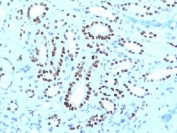 PAX8 Antibody / Tumor Origin Identification Marker Antibody immunohistochemistry in human renal cell carcinoma tissue showing strong nuclear HRP-DAB brown staining in tumor epithelial cells. Paired box protein Pax-8 (PAX8) expression is localized to nuclei of carcinoma cells forming glandular and tubular structures, with clear contrast against surrounding stromal elements that remain largely negative. The staining pattern supports renal epithelial origin, with dense nuclear positivity consistent across tumor cell populations, aiding tumor lineage identification in carcinoma specimens. Required HIER: boil tissue sections in 10mM Tris buffer with 1mM EDTA, pH 9, for 10-20 min followed by cooling at RT for 20 minutes.