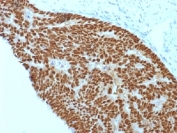 CDX2 Antibody Colon Carcinoma IHC. Immunohistochemistry testing of FFPE human colon carcinoma with CDX2 antibody (clone CDX2/1690). Required HIER: boil sections in 10mM citrate buffer, pH6, for 10-20 min.